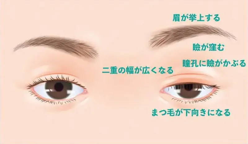 眼瞼下垂の症状のイラスト